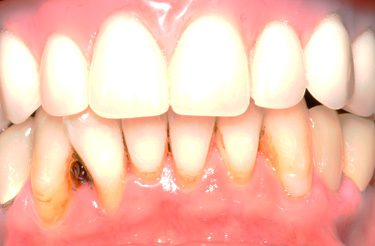 dental-implant-reconstruction-after-image-grand-rapids-michigan