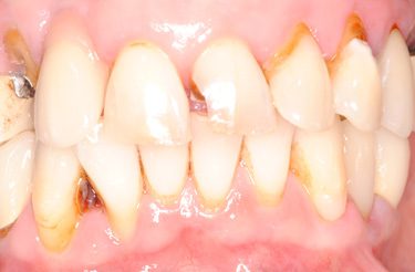 dental-implant-reconstruction-before-image-grand-rapids-michigan