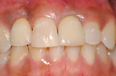 dental-implants-in-grand-rapids-michigan-after-picture