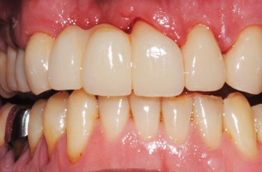 porcelain-bridge-crowns-dentistry-in-grand-rapids-michigan-after