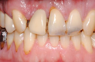 porcelain-bridge-crowns-dentistry-in-grand-rapids-michigan-before