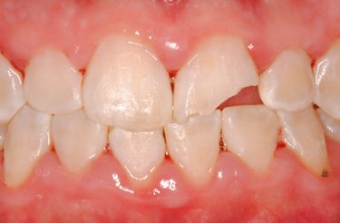 porcelain-crown-dental-work-grand-rapids-michigan-before-picture