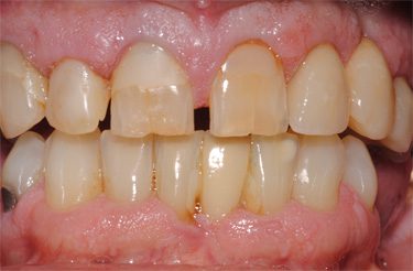 porcelain-crowns-before-picture-dentistry-grand-rapids-michigan